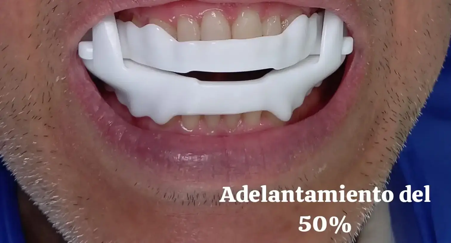 Tratamiento de medicina dental del sueño